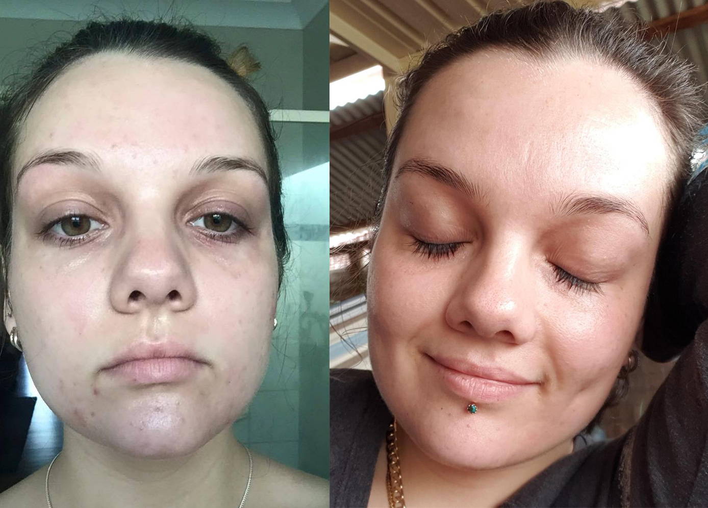 go to skincare acne
