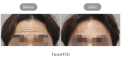 Botox for Men Korea for Natural Forehead Wrinkle Reduction and Preventive Anti-Aging Treatment
