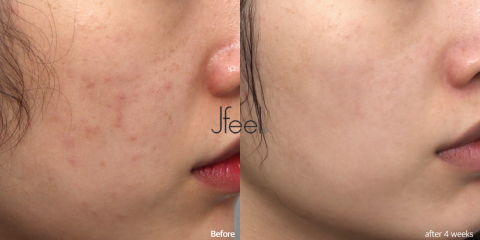 Hydrating Facial Treatment for Redness and Sensitive Skin Before and After Results