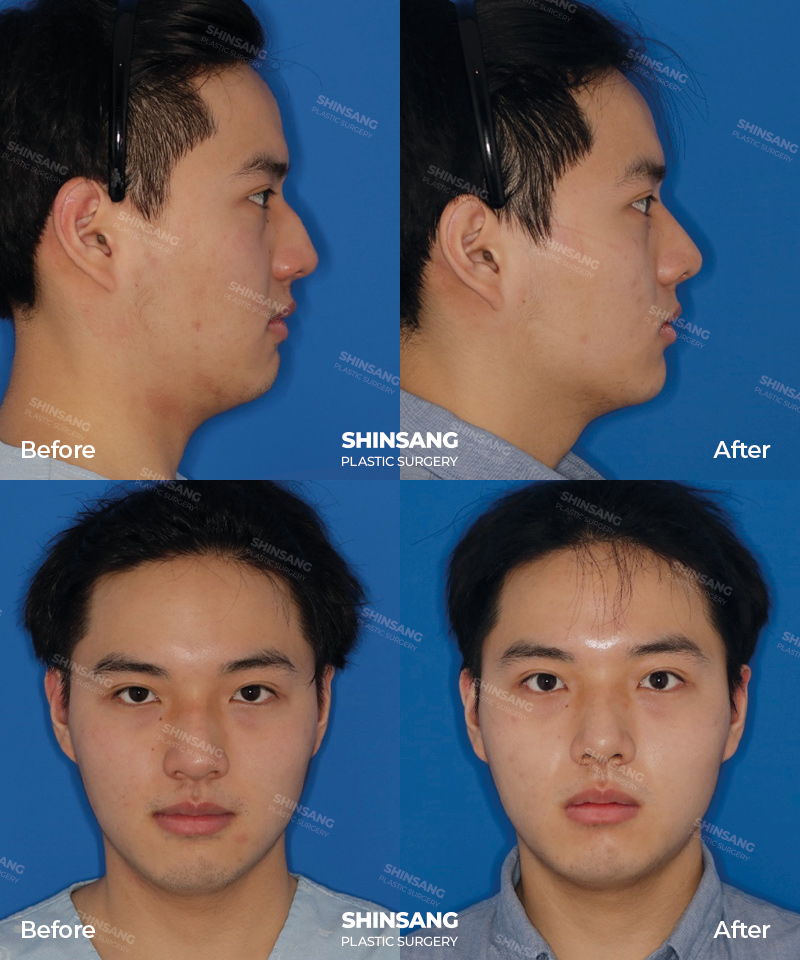 Hump Reduction And Tip Plasty Result Review At Sinsang Plastic Surgery In Korea