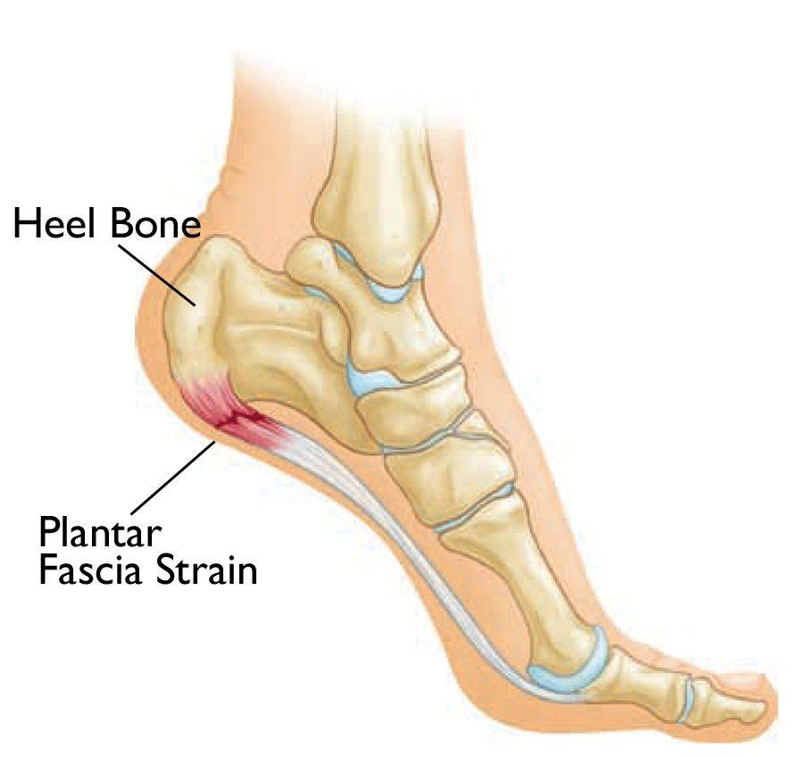 symptoms of plantar fasciitis