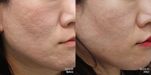 Potenza and Juvelook Skin Before and After Results for Acne Scars and Skin Texture
