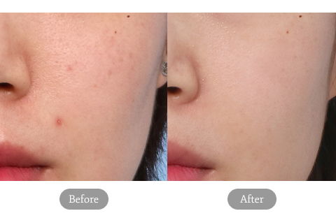 Before And After Result Image Of Rejuran Healer Treatment At Jfeel Clinic