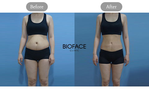 Body HIFU Ulfit Before And After Results For Body Fat Reduction And Skin Tightening In Korea