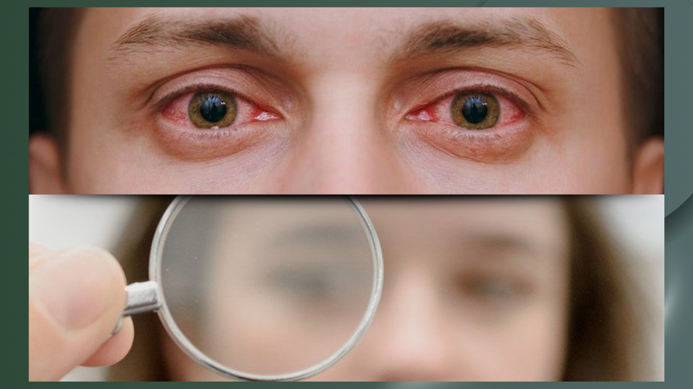 Close-up of red irritated eyes showing signs of dryness, eye strain, or irritation, emphasizing eye discomfort and need for proper eye care