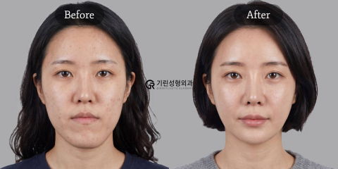 Double Jaw Surgery Before and After in Korea Showing Facial Balance Improvement, Enhanced Jawline Definition, and Natural Facial Harmony