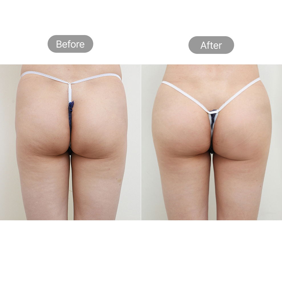 Hip dip fat grafting before and after results for natural hip contouring in Korea