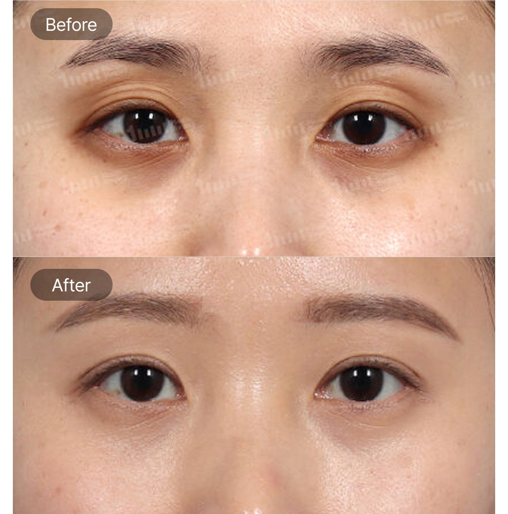 Upper Eyelid Fat Grafting Before and After Results at 1MM Plastic Surgery in Korea for Fuller and More Youthful Eyes