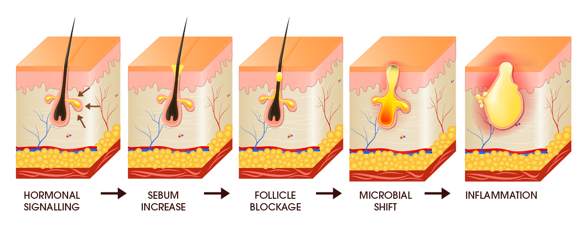 Illustration of acne formation stages.