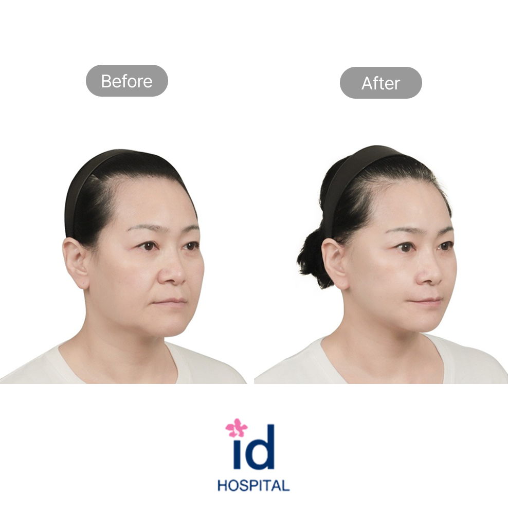 Middle Age Lifting Before and After Result at ID Hospital