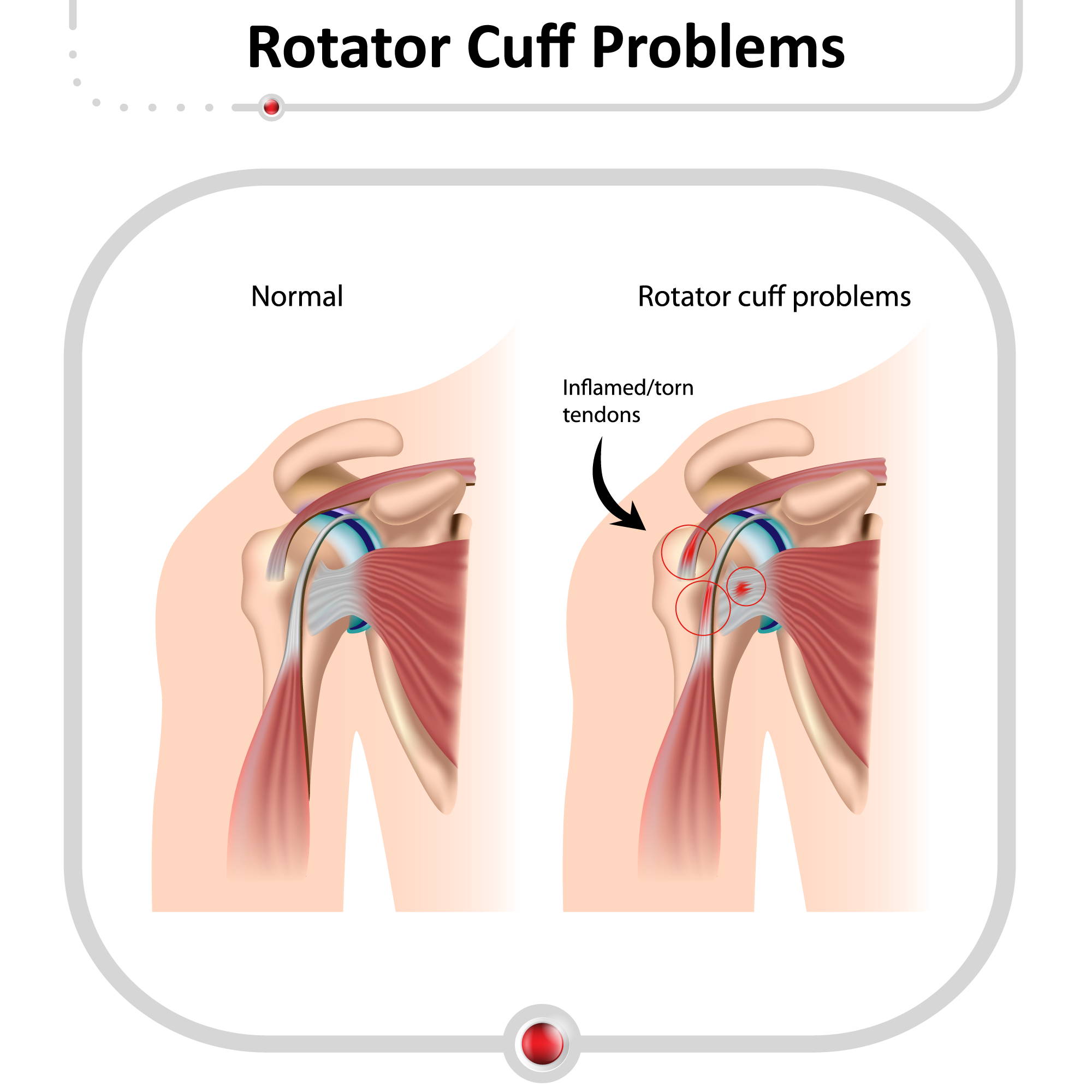 KT Tape Rotator Cuff  Taping Shoulder [Injury & Stability]