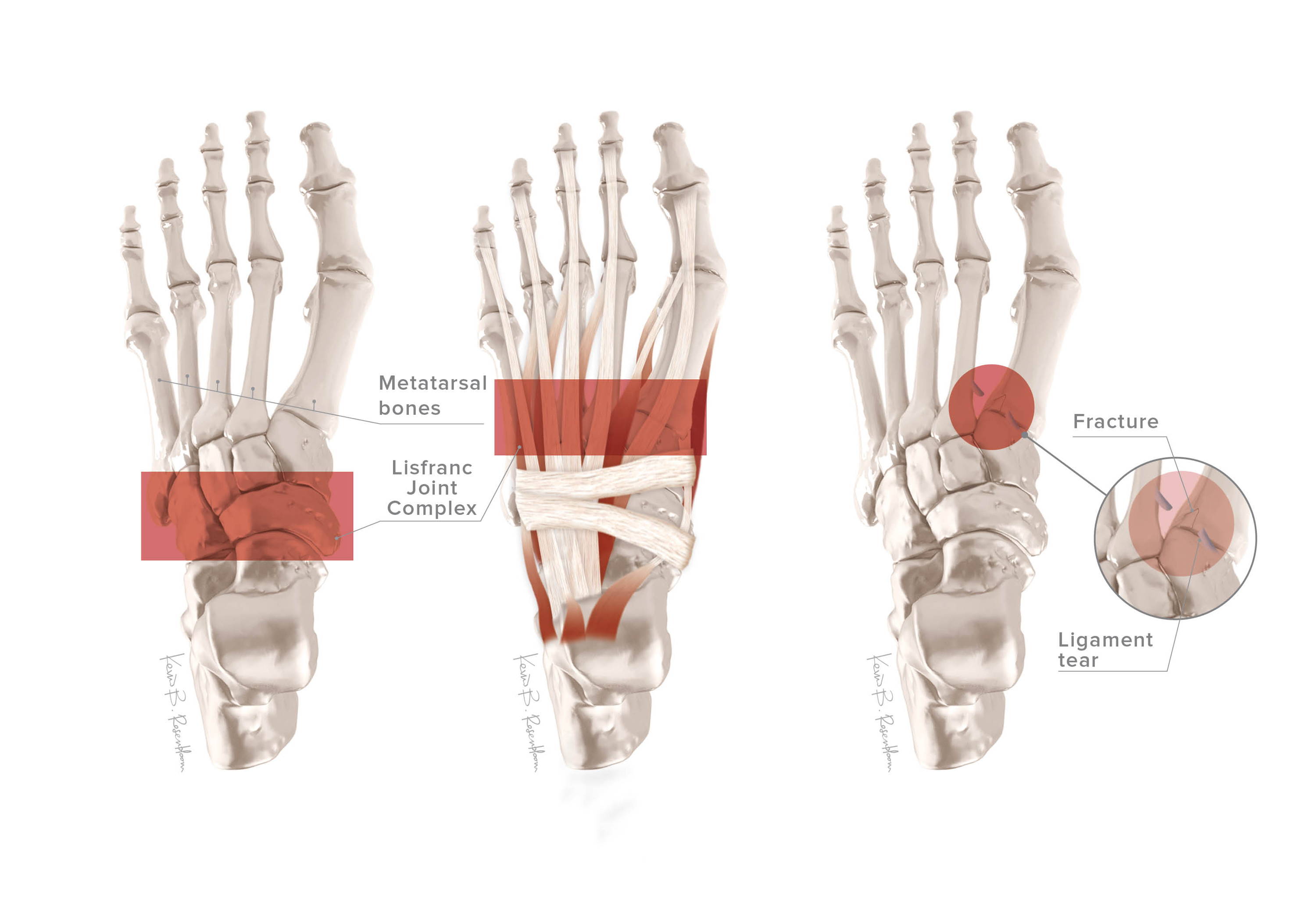 Lisfranc Injuries