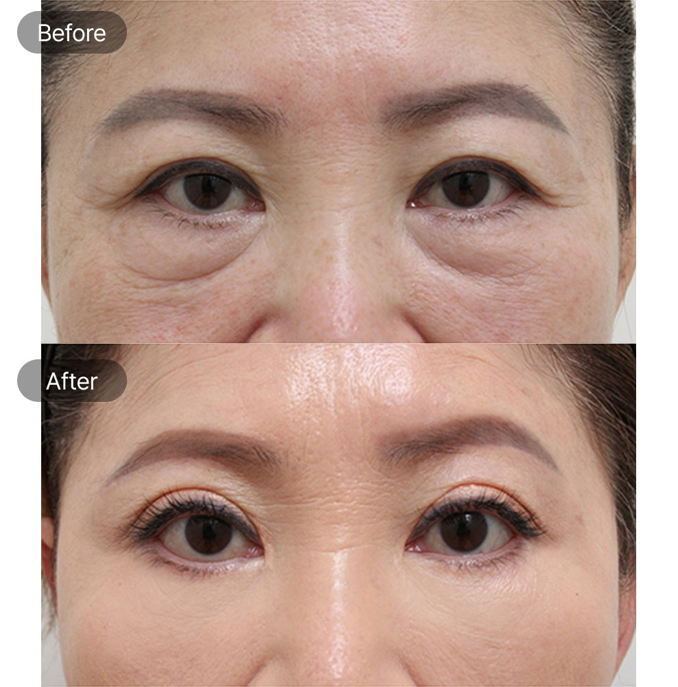 Upper eyelid lift before and after results for brighter eyes at Fresh Dr. Hong in Korea