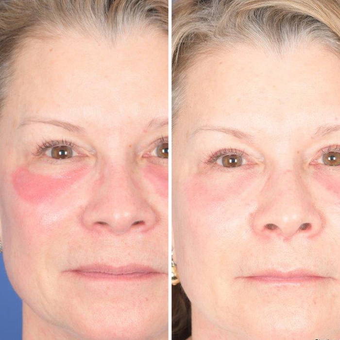 Before and after photos chemical peel