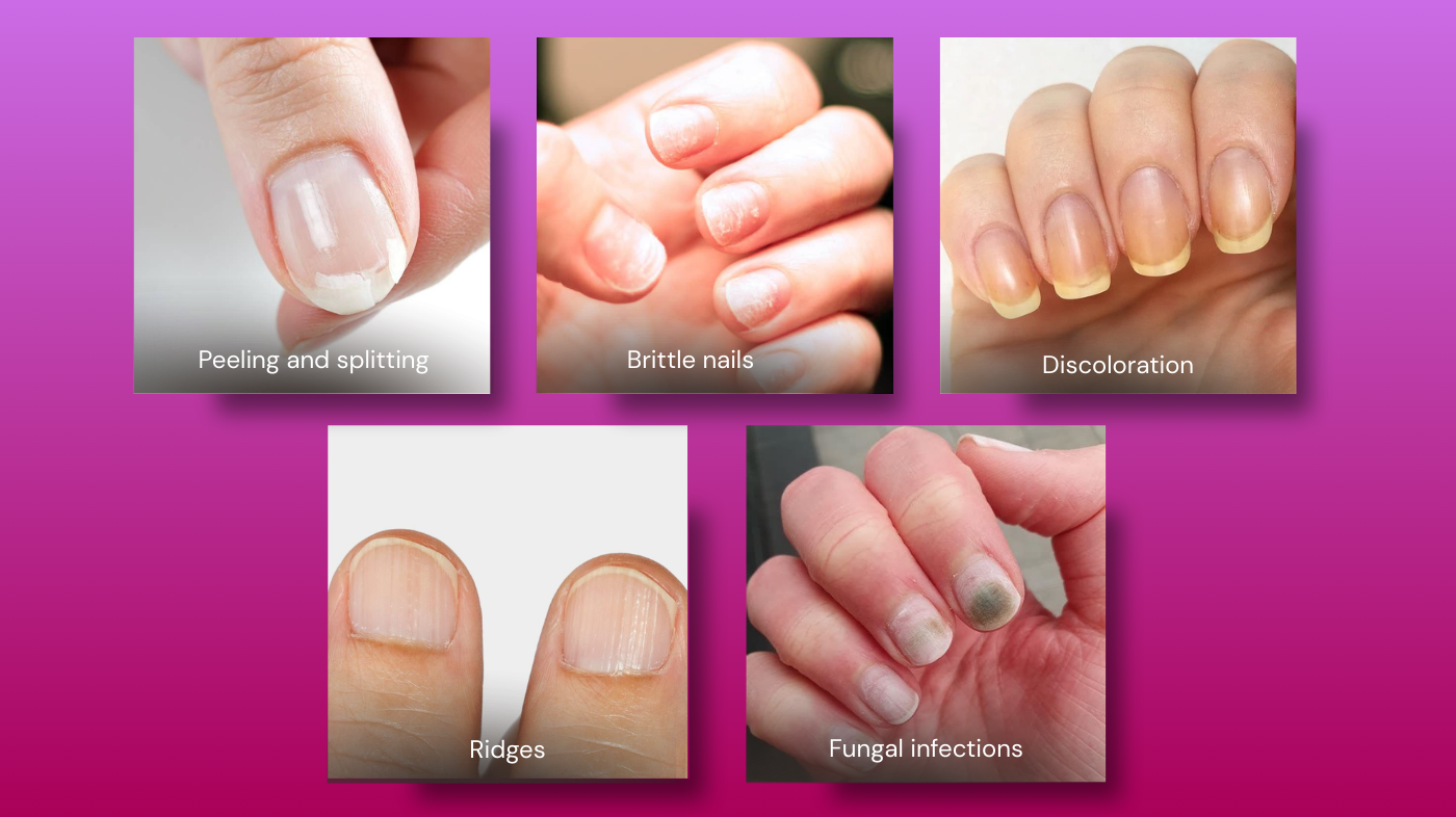 Illustration of common nail problems and their causes, showing peeling, splitting, brittle nails, ridges, discoloration, and signs of fungal infections or trauma