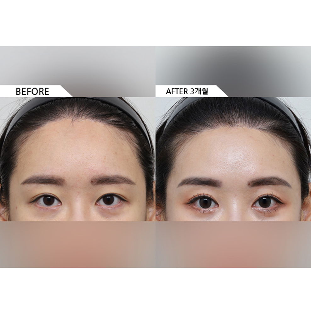 Before and after results of forehead reduction and brow lift surgery showing a lowered hairline, lifted brows, and brighter eye appearance 3 months after surgery in Korea