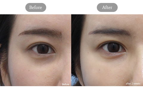 Before And After Review Image Of Under-Eye Filler Treatment At Jfeel Clinic