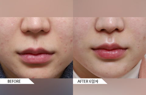 Subnasal lip lift before and after treatment with reduced philtrum length and improved upper lip projection