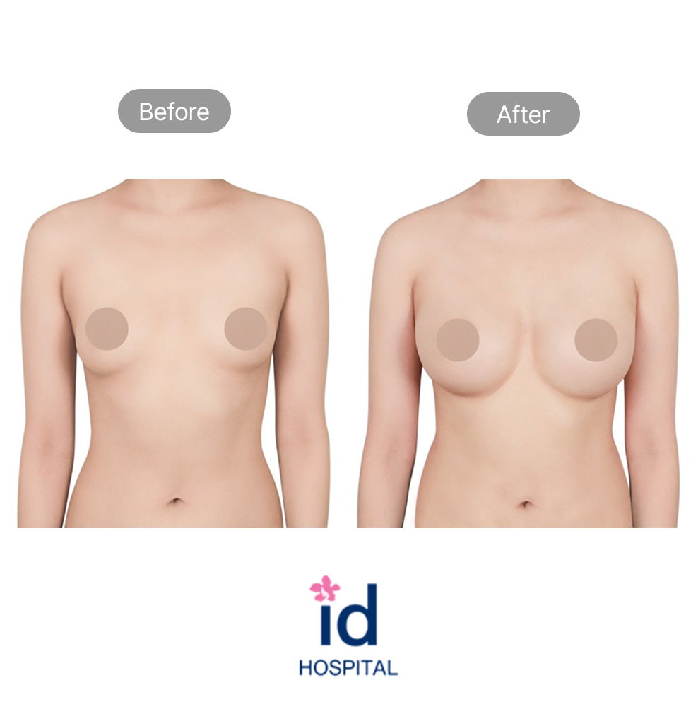 Motiva Breast Augmentation Before and After Result at ID Hospital