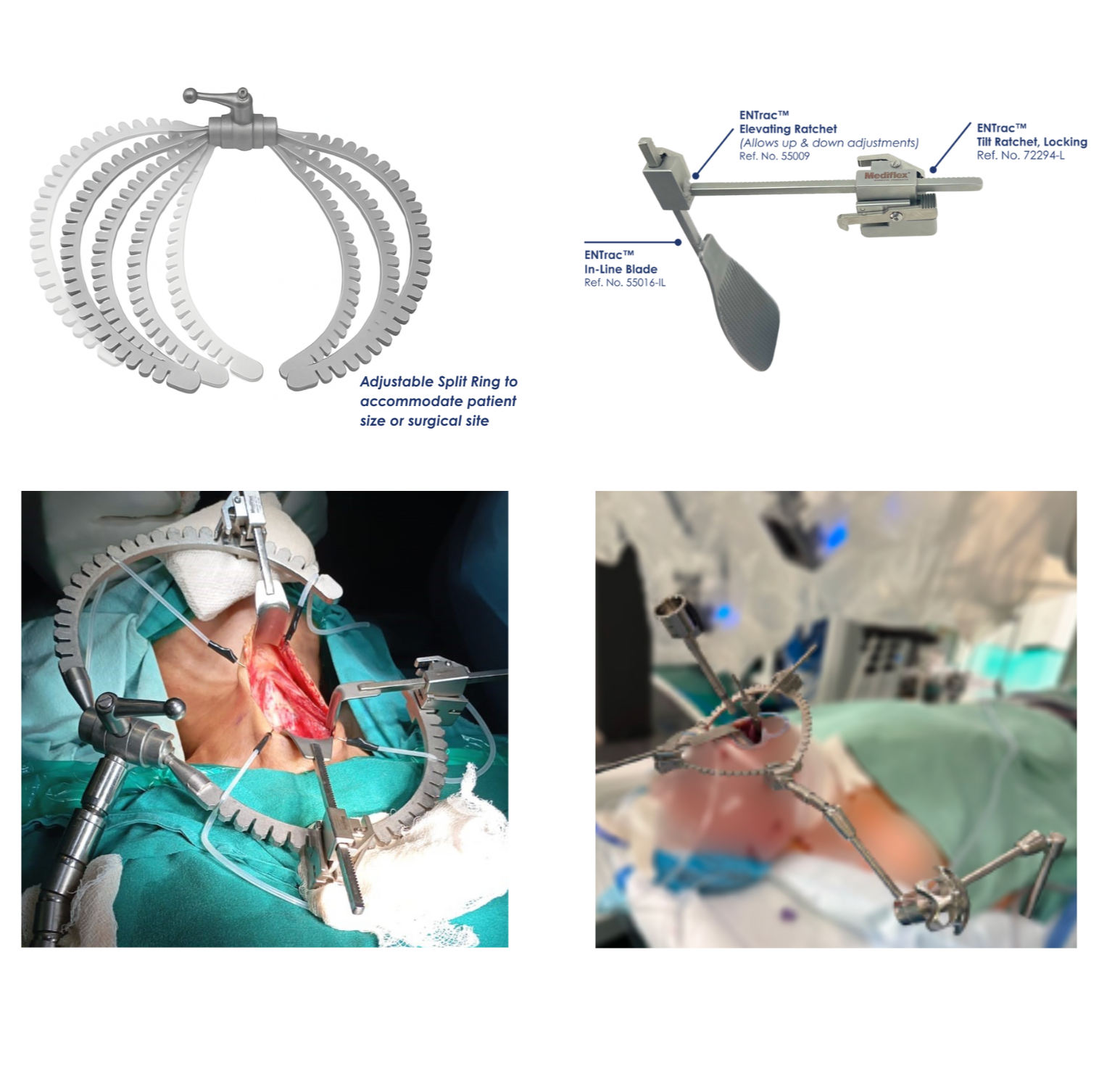 ENTrac™ Retraction Systems – Mediflex Surgical Products