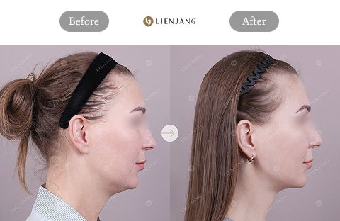 Total V Line Surgery in Plastic Surgery Korea With Face Fat Removal Before and After Six Months