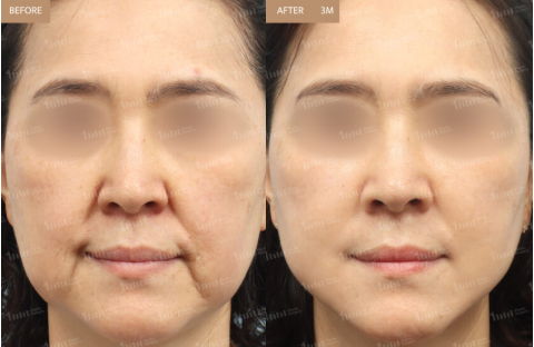 Combined thread lift and fat grafting results for sagging skin showing restored facial volume and lifting effect after 3 months