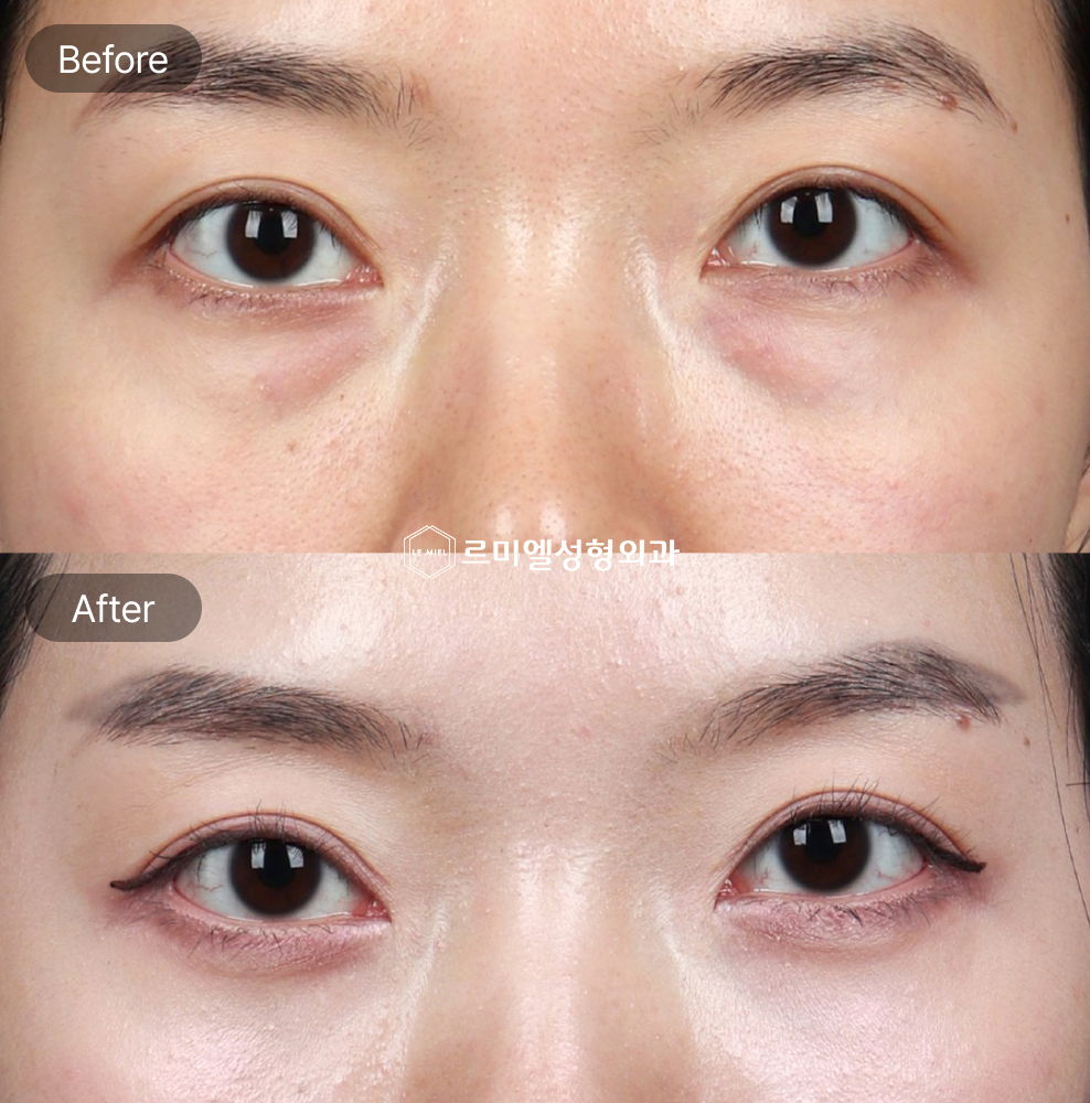 Before and After Results of Under Eye Fat Repositioning, Rejuran Treatment, and Foreign Body Removal Surgery After Four Months