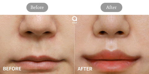Philtrum shortening and corner lip lift before and after results showing enhanced lip contour and facial balance