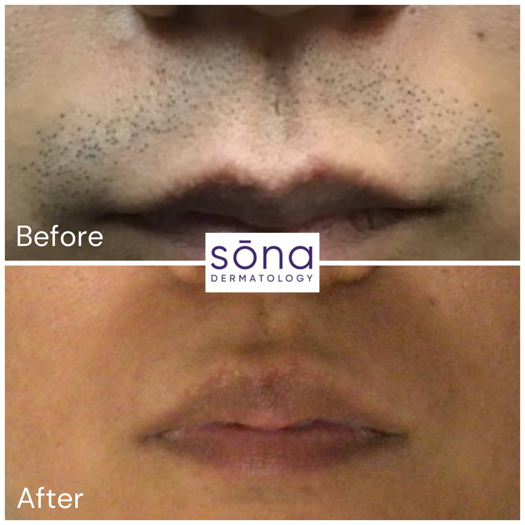 Sona Motus AY Laser Hair Removal Before & After 5