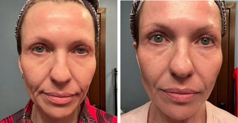 Before and after comparison of a woman's facial appearance.