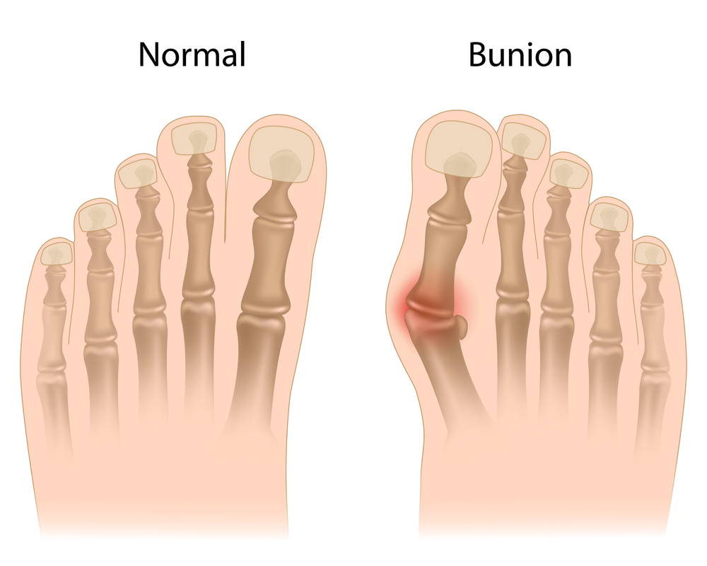 How Can I Get My Bunion Treated? Premier Foot & Ankle Center