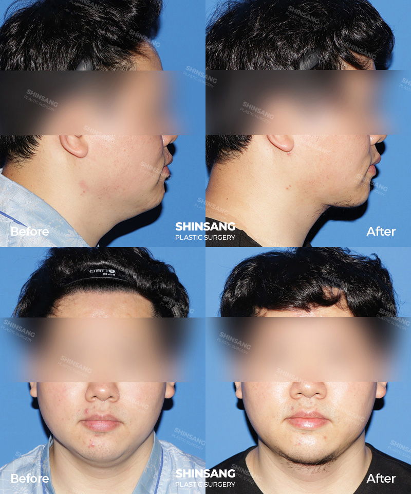 Toad Neck Surgery Before And After Patient Review At Sinsang Plastic Surgery In Korea