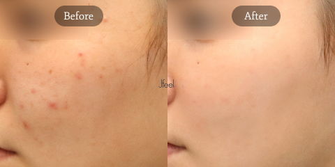 Exosome Therapy for Acne Pigmentation Reduction and Advanced Korean Skin Regeneration Treatment
