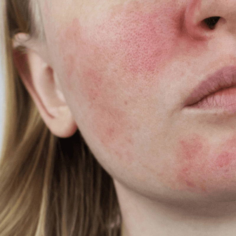 Woman with sensitive skin and redness.