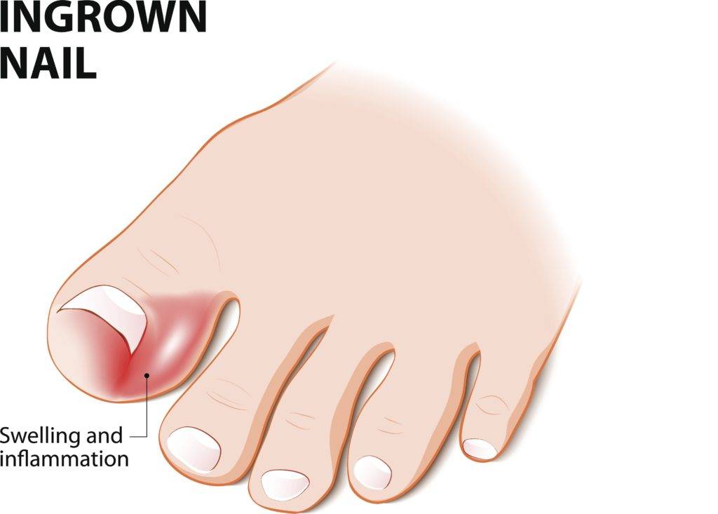 How To Get Rid Of A Painful Ingrown Toenail | Premier Foot & Ankle Center