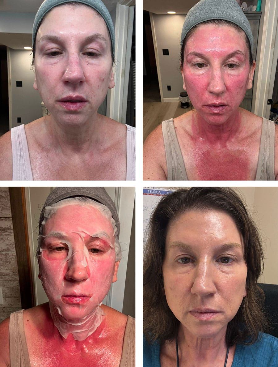 Woman with facial treatments, showing redness and recovery in four images.