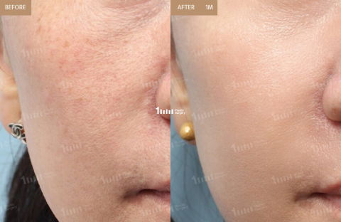 1 month Juvelook treatment results improving skin texture and pores as a Korean filler alternative for natural skin rejuvenation
