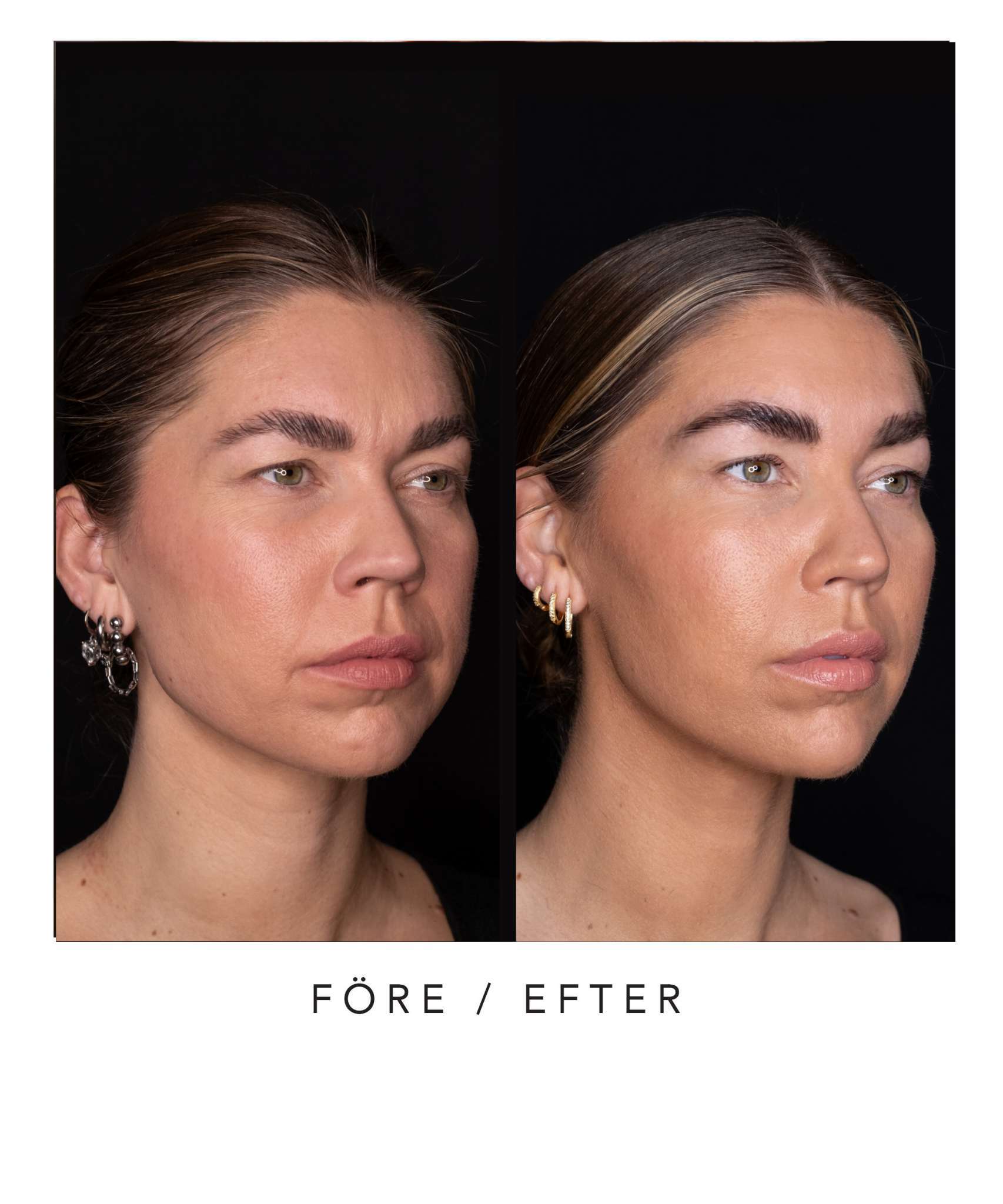 Before and after portrait of a woman showing facial transformation.
