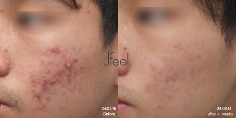 Agnes Acne Treatment Showing Four Week Improvement in Active Breakouts