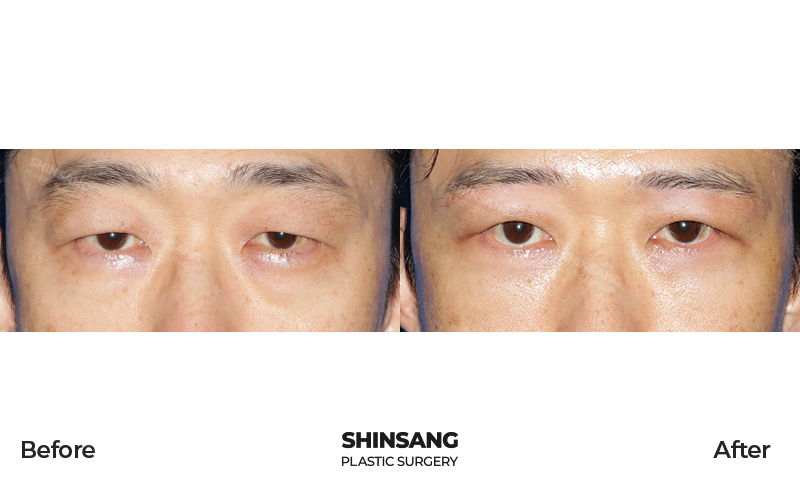 Sub Brow Lift And Lower Blepharoplasty Result At Sinsang Plastic Surgery In Korea