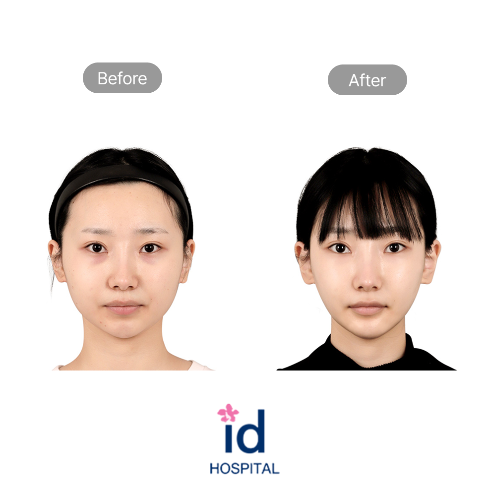 Facial Contouring Two Procedures, Cheekbone Reduction, Chin Reduction, and Mini V-Line Before and After Result at ID Hospital