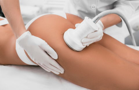 Noninvasive Liposuction Treatment for Body Fat Reduction Without Surgery
