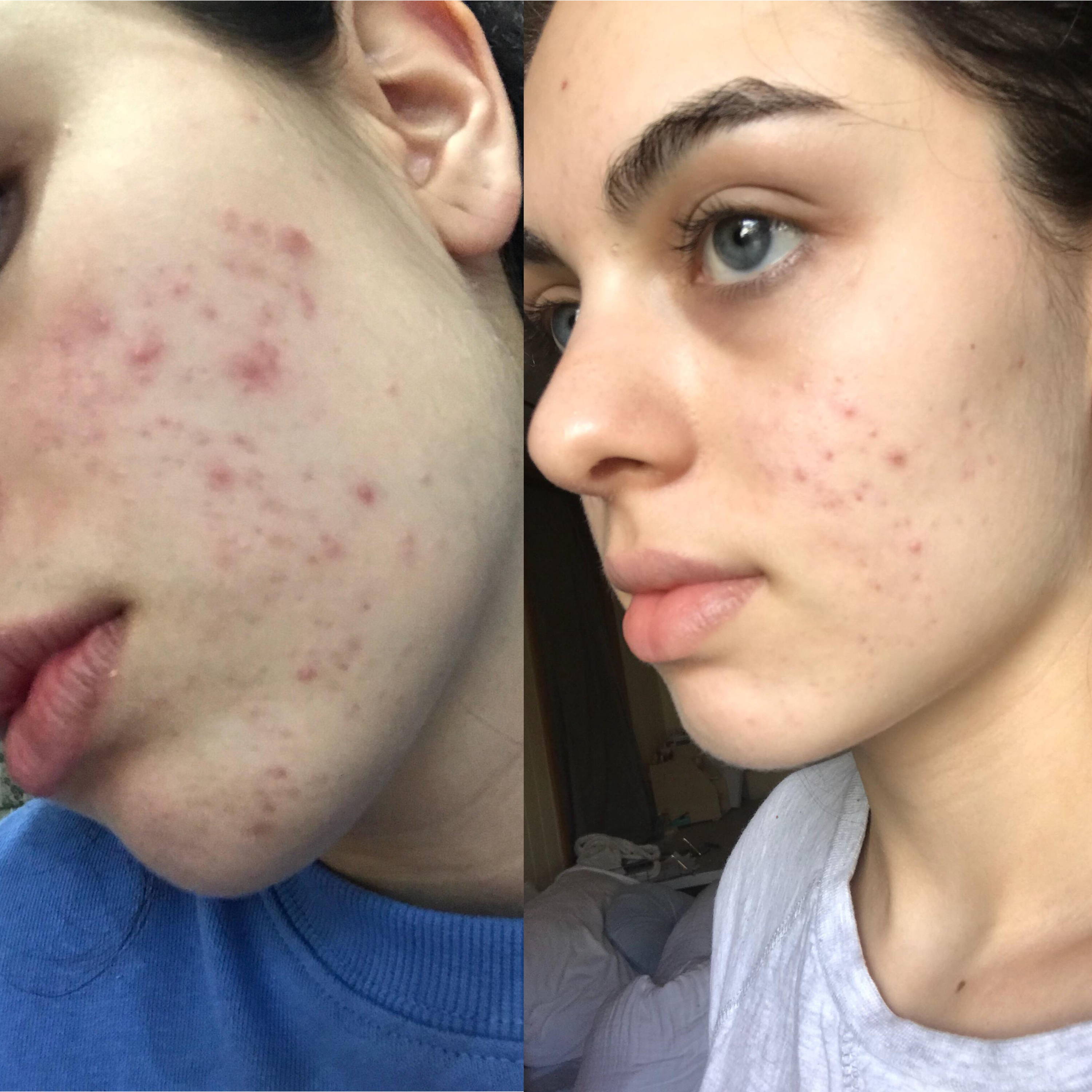 go to skincare acne