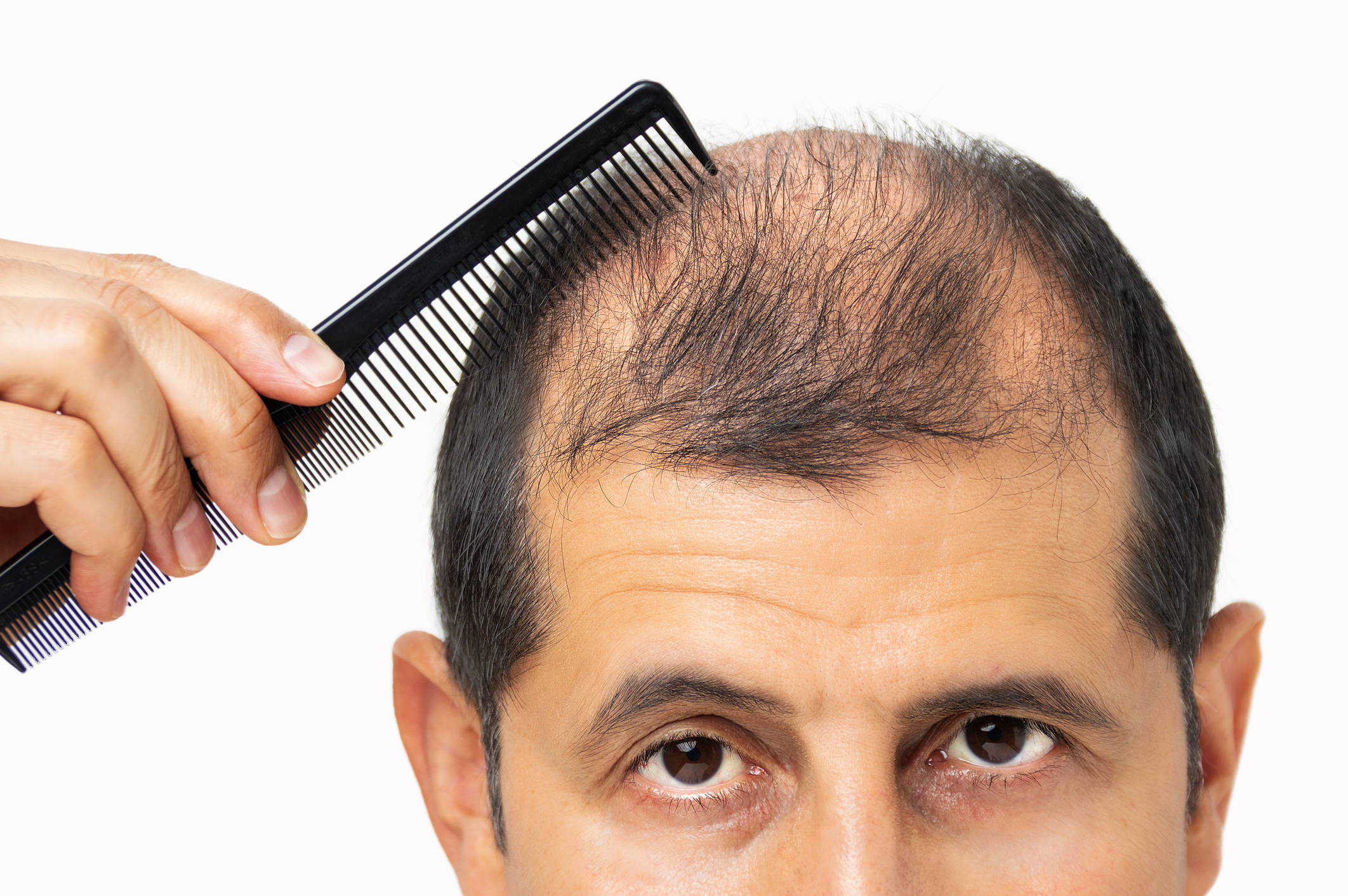 Understanding the Relationship Between Hair Loss & Testosterone – DS  Healthcare Group