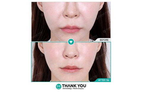 Radiesse Filler Nasolabial Fold Lifting Before and After 1 Month – Cosmetic Procedure in Korea by Jivaka Beauty