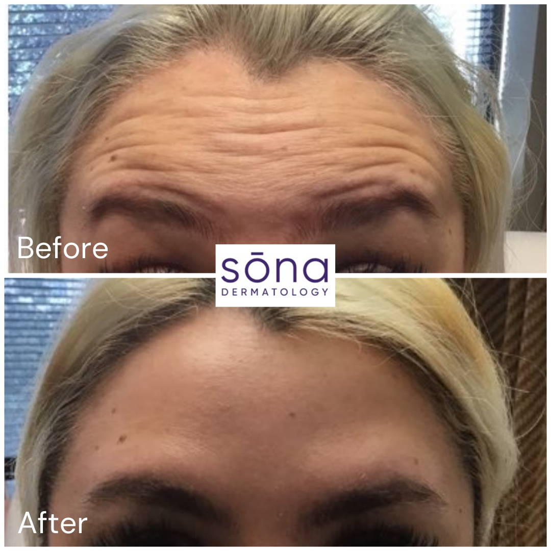 Sona - Botox Cosmetic Before & After 13