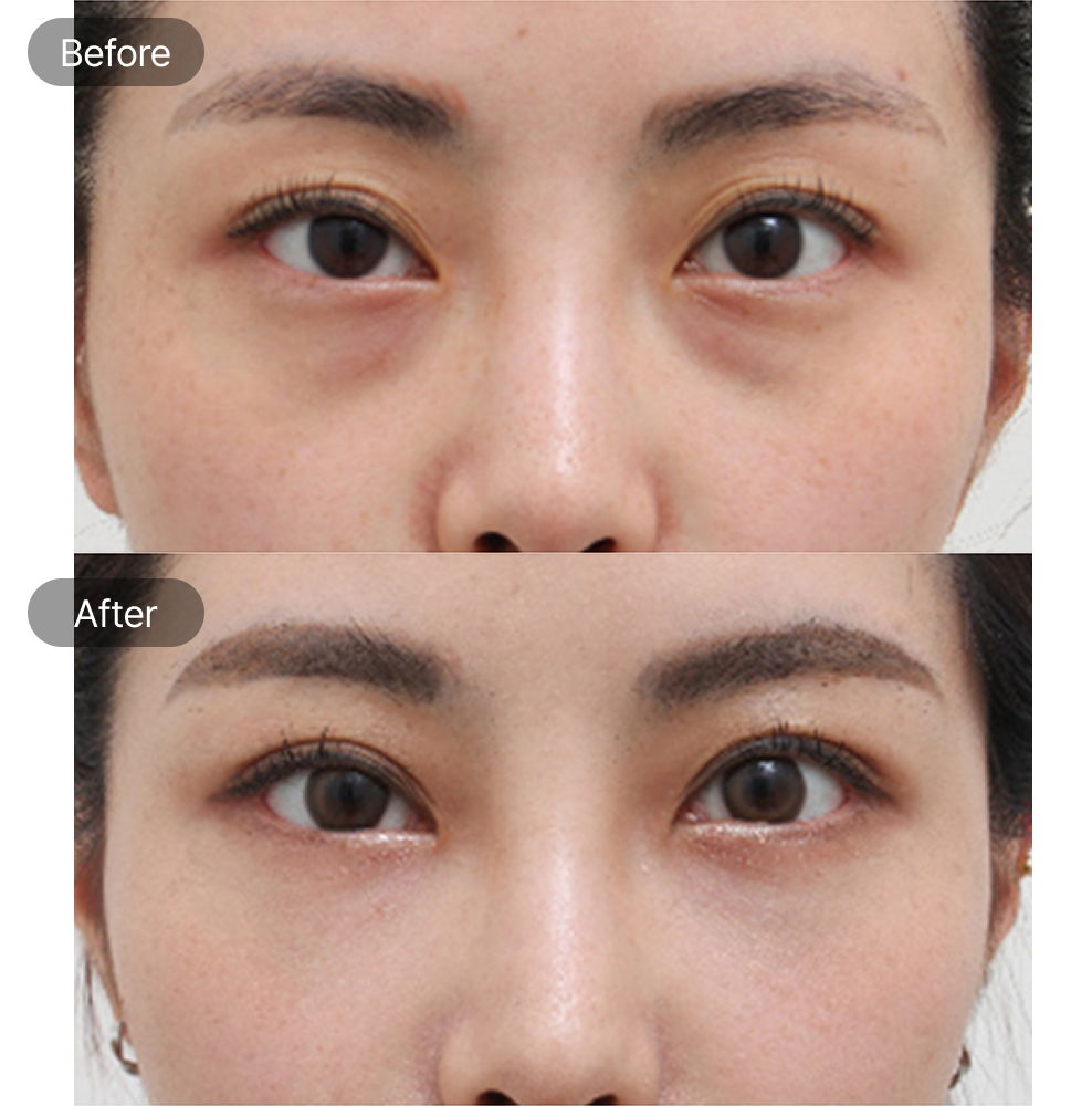 Under eye bag treatment before and after results at Fresh Dr. Hong Plastic Surgery in Korea