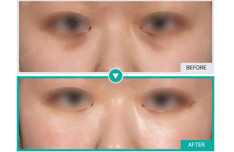 Before And After Review Image Of Non-Surgical Under-Eye Fat Repositioning At Thank You Plastic Surgery Clinic In Korea