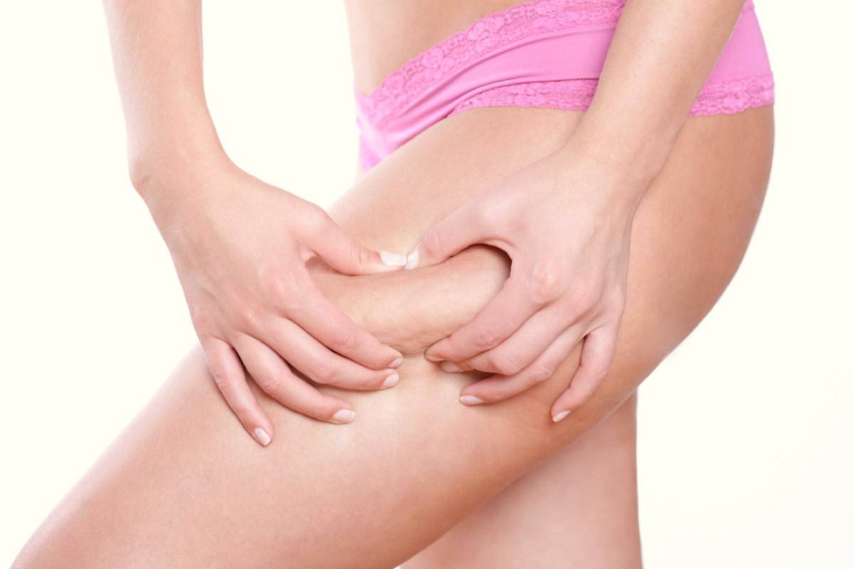 See This Report on How Much Does Cellulite Reduction Cost? - New York thumbnail