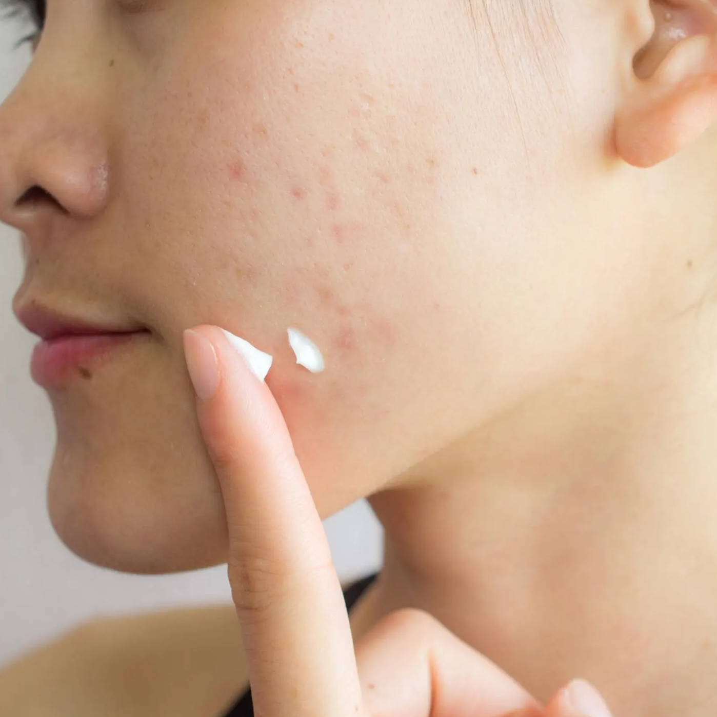 Woman with oily skin and acne applying moisturizer